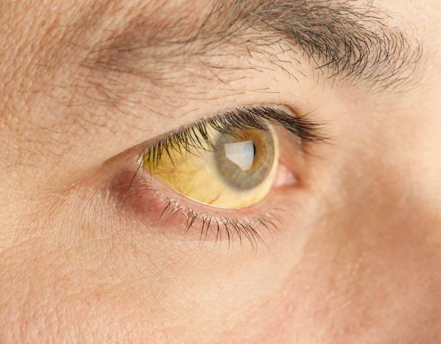 гепатоз. желтая склера глаз