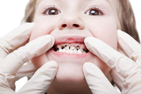 черные зубы у детей причины