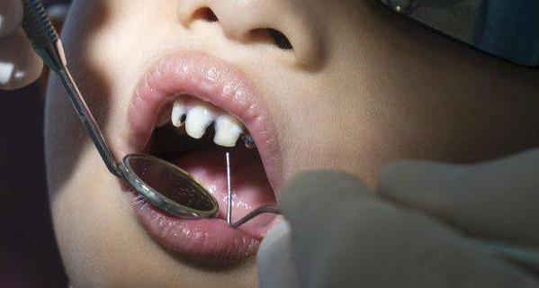 черные пятна на зубах у ребенка