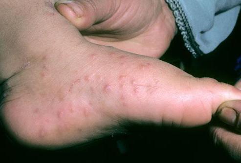 Сыпь на ладонях и ступнях у взрослых после температуры название thumbnail