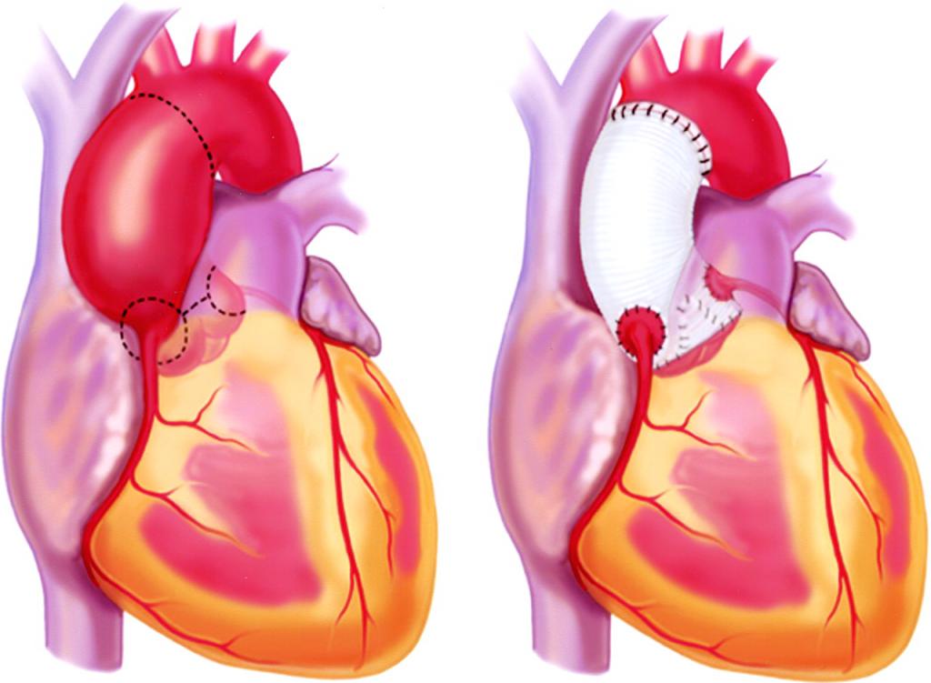 Особенности аневризмы сердца