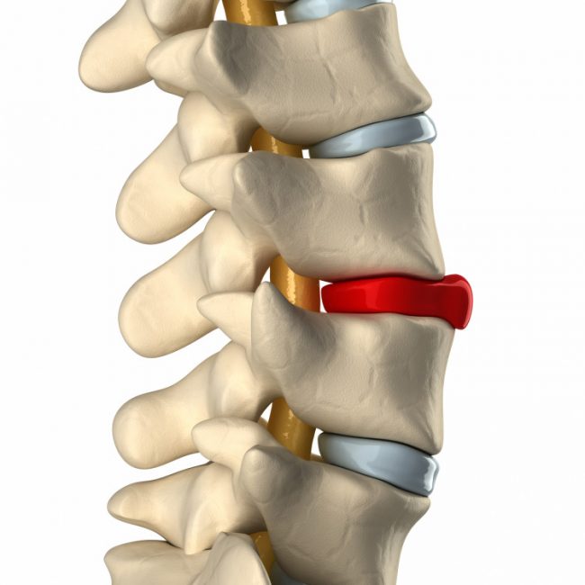 Compression fracture of the spine