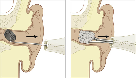 Извлечение инородного тела из уха