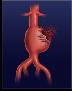 аневризма грудного и брюшного отдела аорты