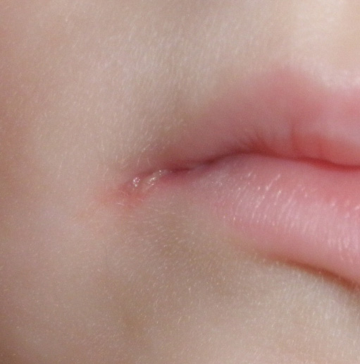 Трещина в уголке губы у ребенка