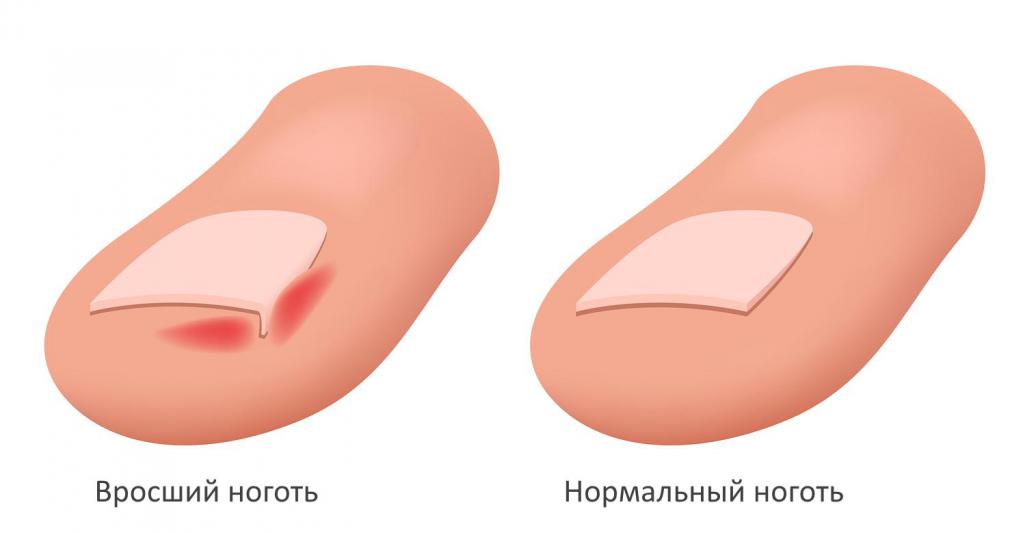 Ногти на ногах врастают в пальцы: причины, симптомы, диагностика, клиническое и оперативное лечение, профилактика