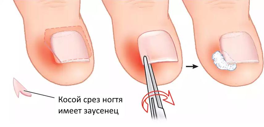 Ногти на ногах врастают в пальцы: причины, симптомы, диагностика, клиническое и оперативное лечение, профилактика