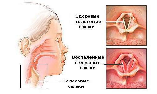 Синдром крупа