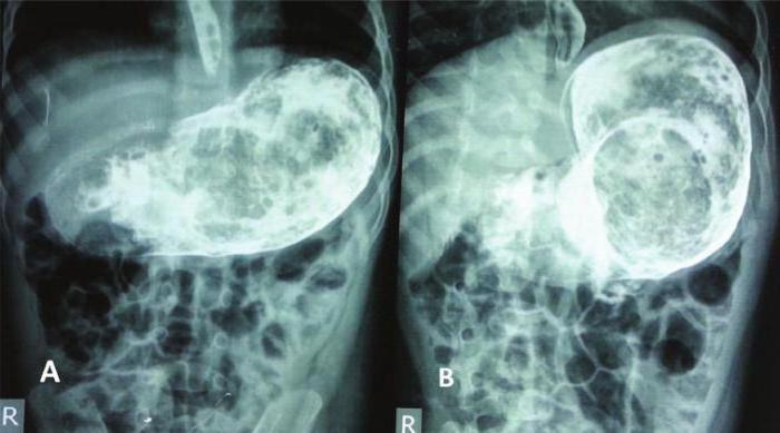 Рентген желудка показывает гастрит thumbnail