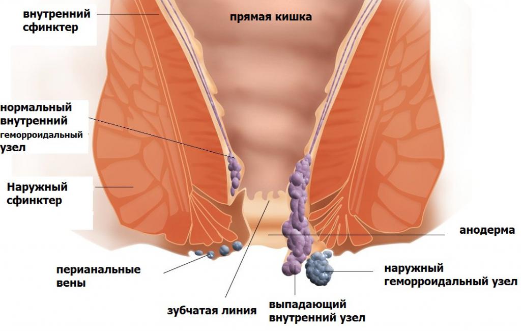 Признаки геморроя у женщин