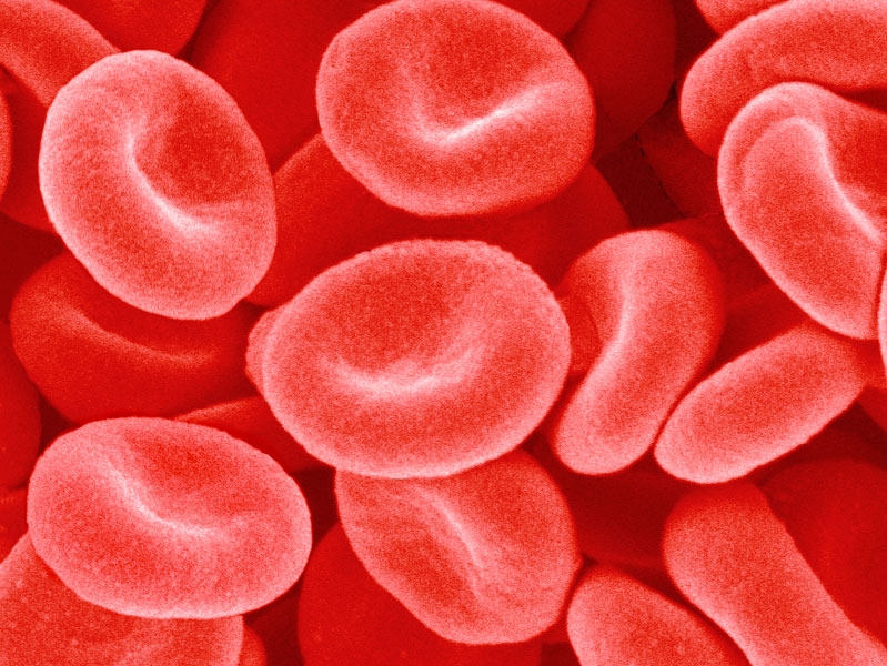 Серповидноклеточная анемия - мутация гена.