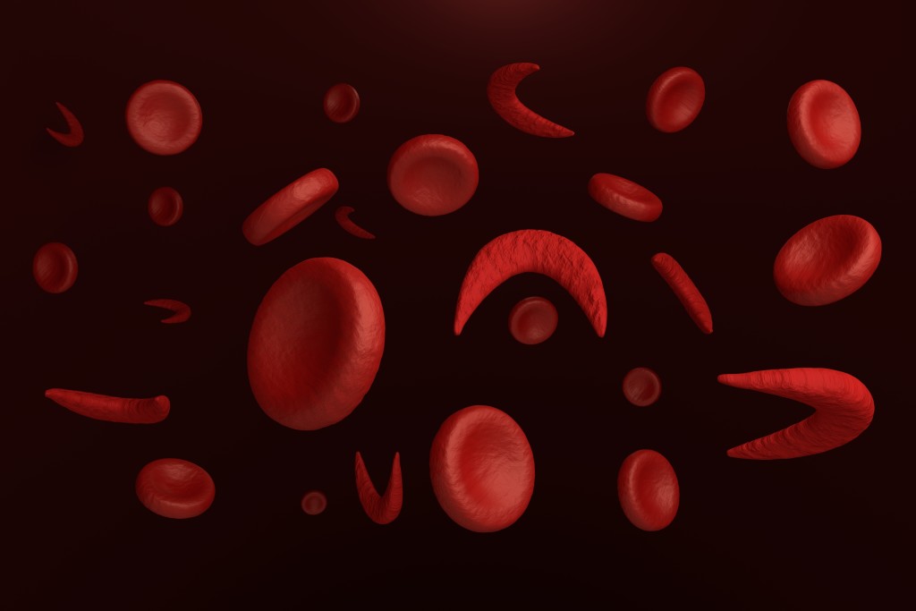 Форма клеток при серповидноклеточной анемии