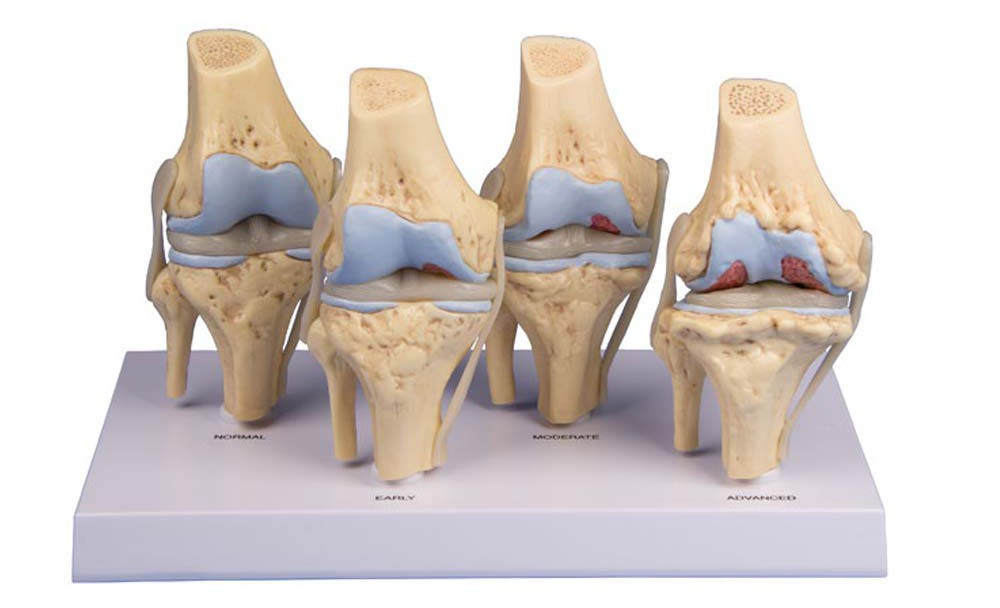 различные степени остеоартроза колена