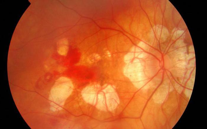 Ингибиторы карбоангидразы для лечения глаукомы thumbnail