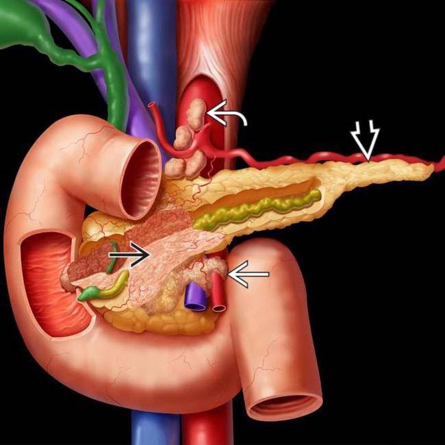 Эхографические признаки диффузные изменения ткани поджелудочной железы thumbnail
