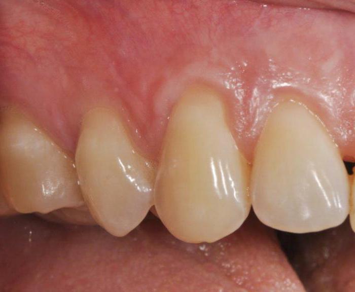 Цвета зубов при синдроме стентона капдепона thumbnail