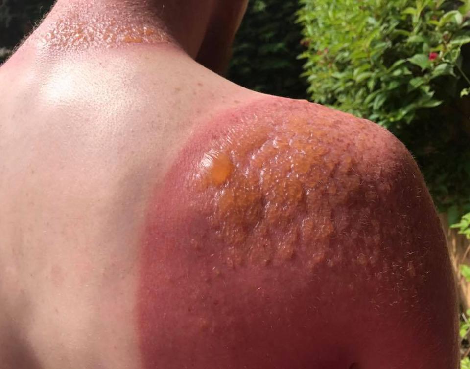 аллергия на солнце лечение