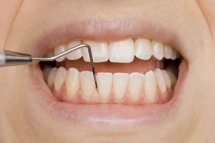 лечение периодонтита молочных зубов
