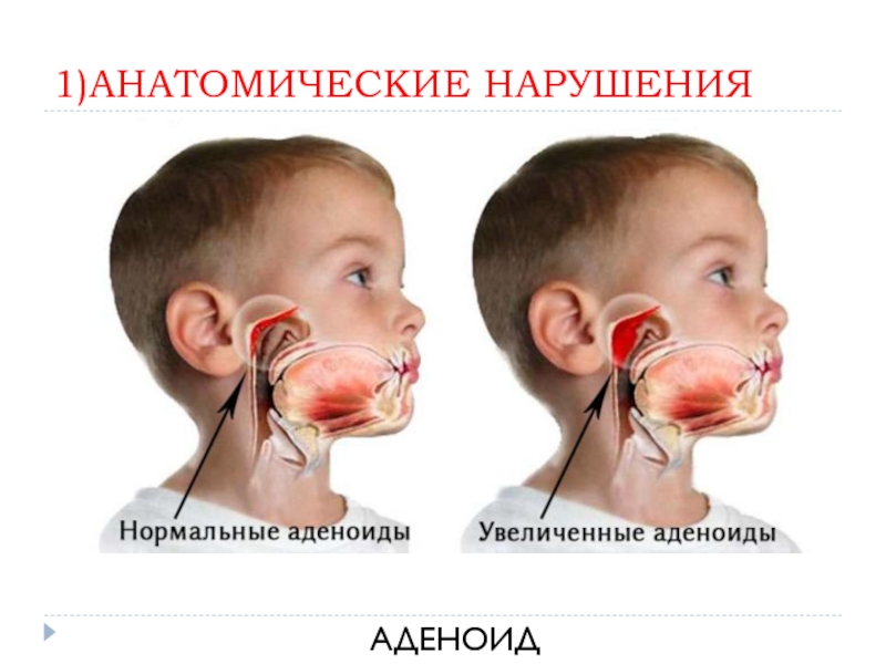 Картинки удаление аденоидов