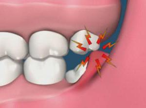 Удаление зуба при лечении хронического периодонтита thumbnail