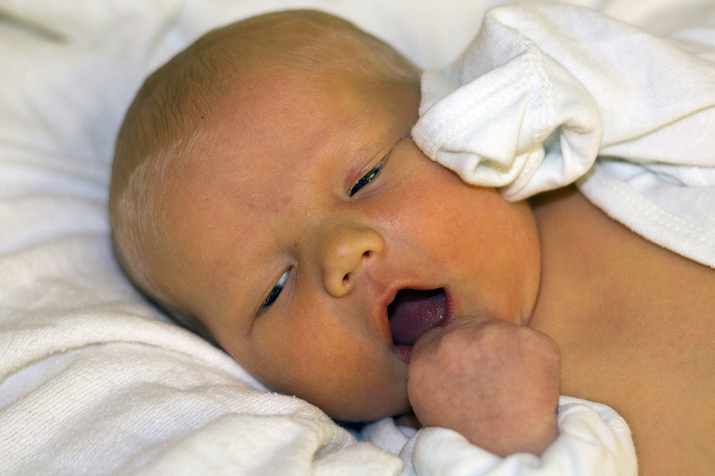 Физиологическая желтуха у новорожденных фото