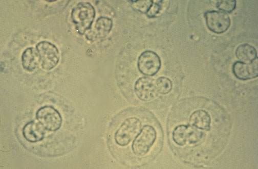 urine protein and white blood cells