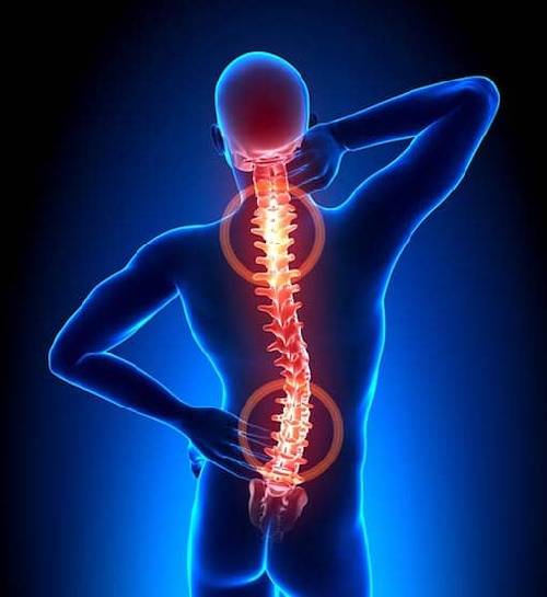 extravasal compression of the left vertebral artery