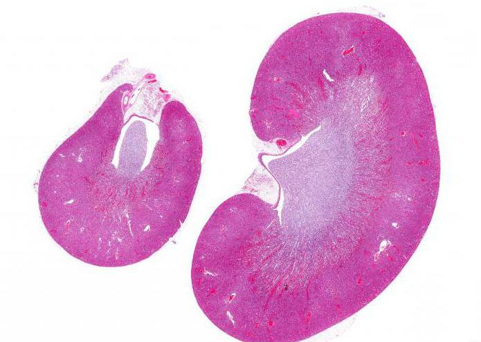 гистология опухоли почки 