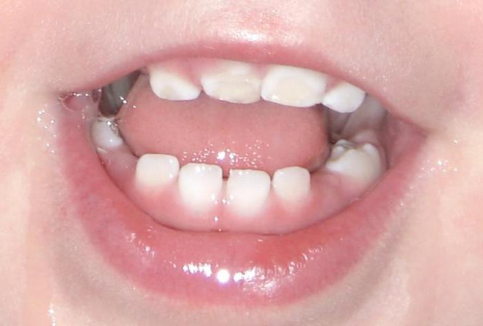 гипоплазия эмали молочных зубов 