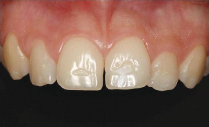 гипоплазия эмали постоянных зубов 