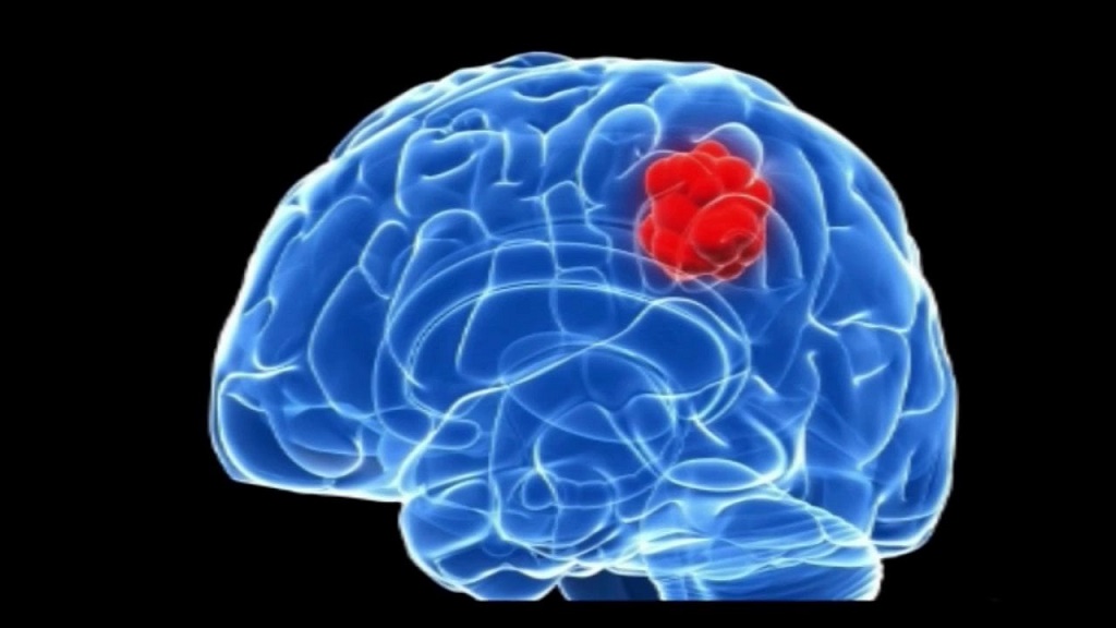 доброкачественная опухоль головного мозга симптомы сколько живут