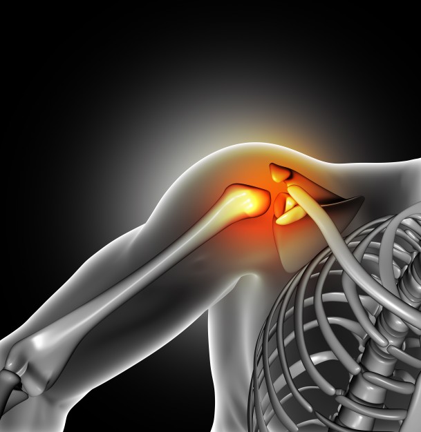 перелом шейки плечевого сустава