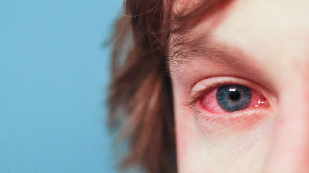 Покраснение глаз при аллергии