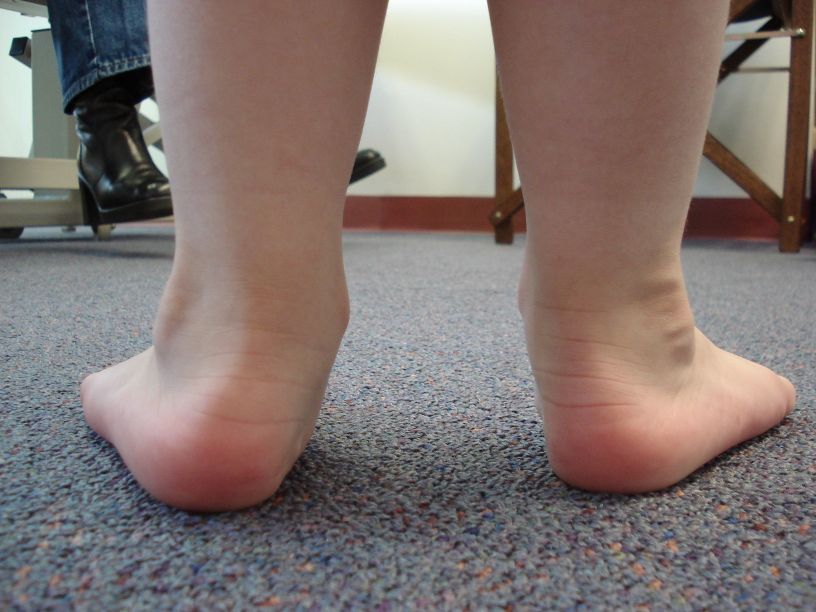 Плоскостопие фото стопы у ребенка