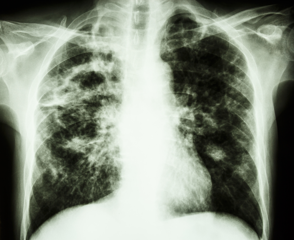 Рентгенограмма грудной клетки туберкулез