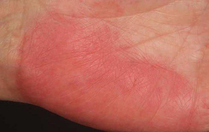 Влияние заболеваний печени на состояние кожи | Клиника ЭКСПЕРТ