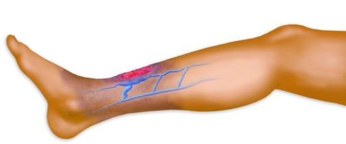 Тромбы в венах на ногах народное лечение thumbnail