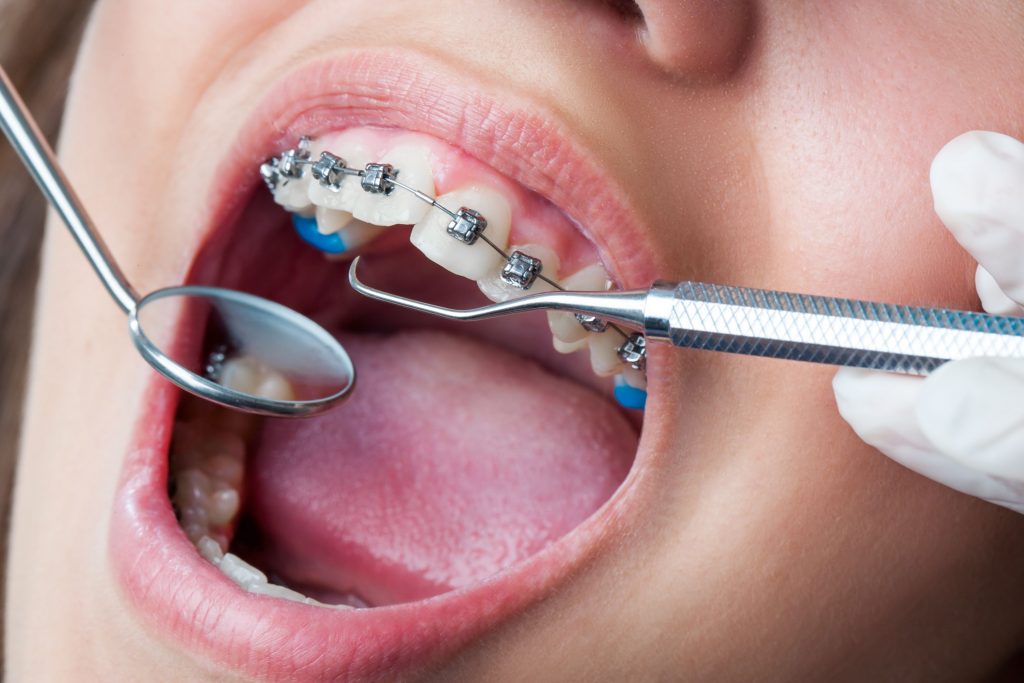 реставрация зубов коррекция