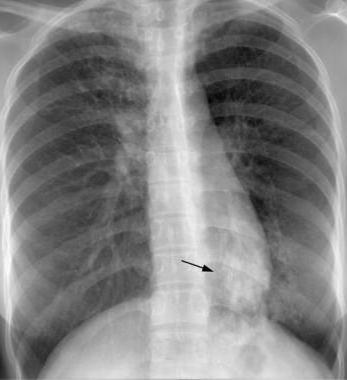 покажет ли рентген туберкулез легких