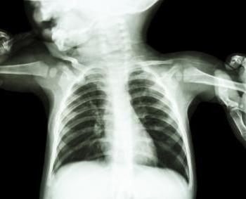 рентген показывает воспаление легких