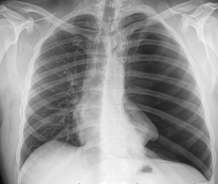 Какие болезни легких не показывает рентген thumbnail