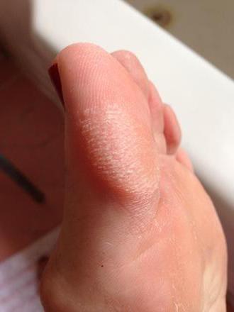 Натоптыши на пальце ноги лечение быстрое избавление в домашних условиях thumbnail