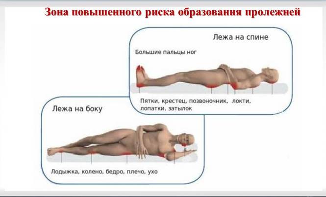 Места локализации пролежней