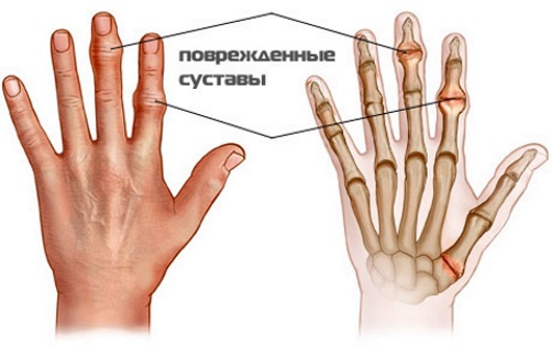 Артроз суставов пальцев