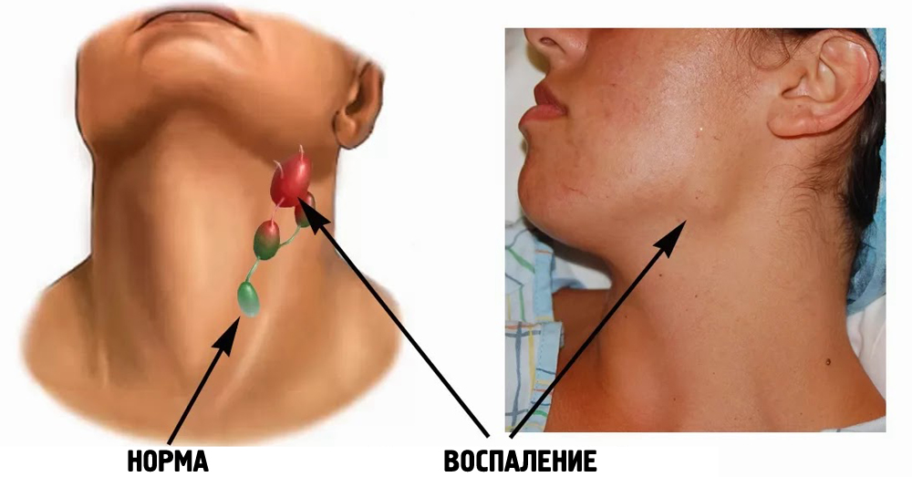 Inflamed lymph nodes