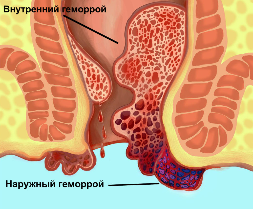 Наружный и внутренний геморрой