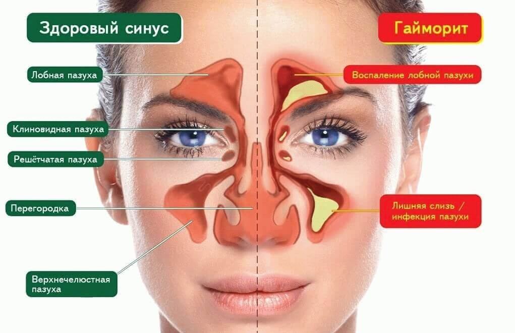 Состояние пазух при гайморите