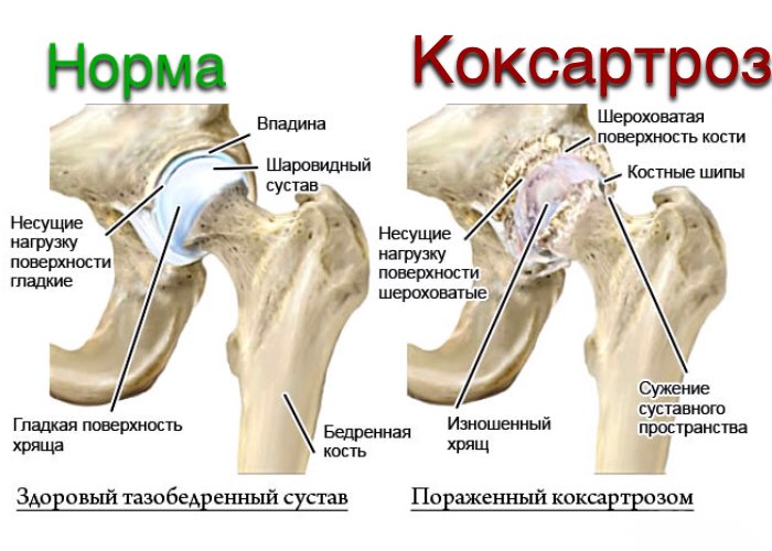 Тазобедренный сустав фото