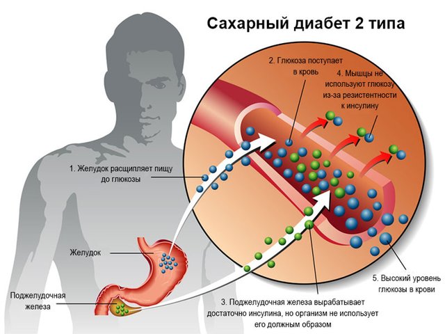 Диабет второго типа