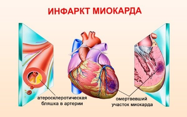 Абдоминальная форма инфаркта миокарда: симптомы, первая помощь и лечение
